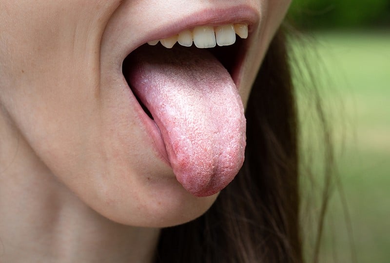 The 15 Causes Of Sore Tongue You Should Be Aware Of OptingHealth