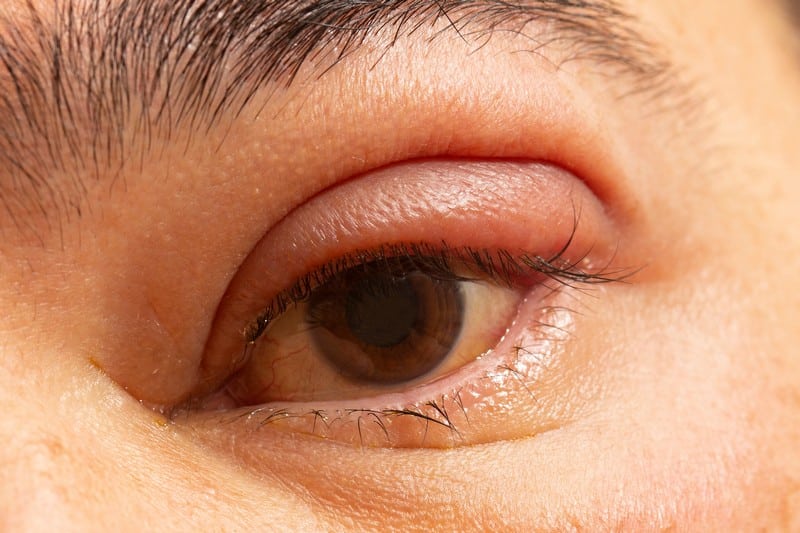 The Causes Of Swollen Eyelid You Should Definitely Be Aware Of