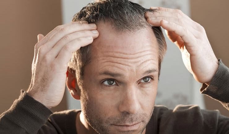 How To Regrow Hair Naturally Stop Hair Loss Alopecia Areata