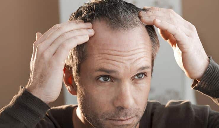 how-to-regrow-hair-naturally-stop-hair-loss-alopecia-areata