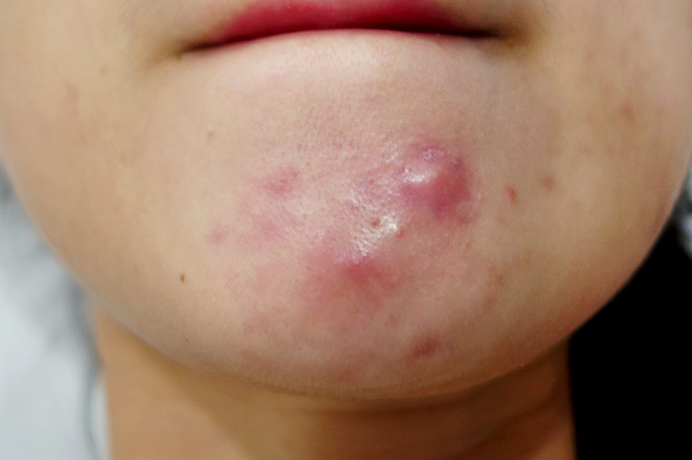 cystic acne hot or cold compress