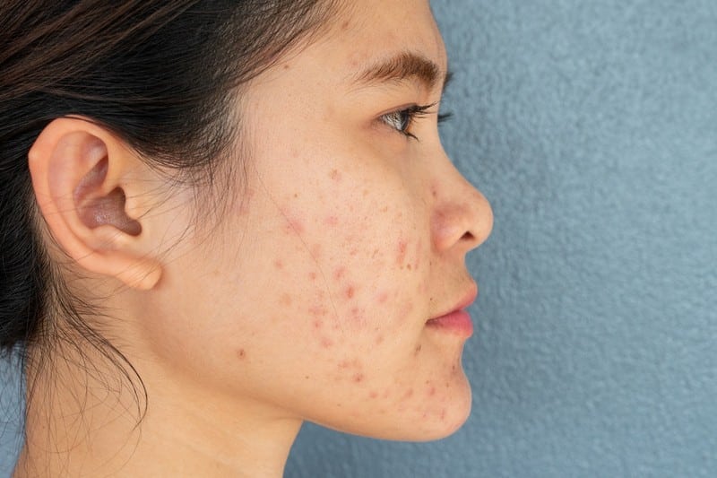 15-effective-acne-scars-home-remedies-you-should-try-optinghealth