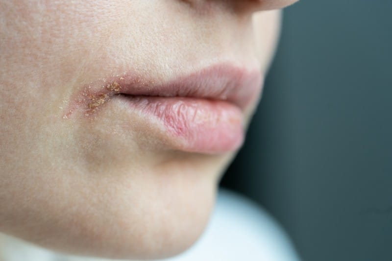 cold-sore-12-best-ways-to-treat-according-to-professionals