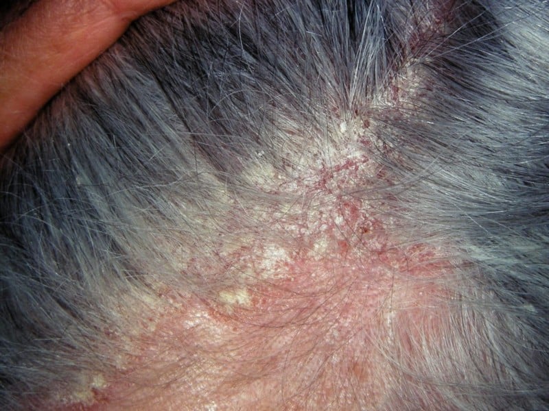 9 Itchy Scalp Causes You Should Know (Common Triggers) - OptingHealth