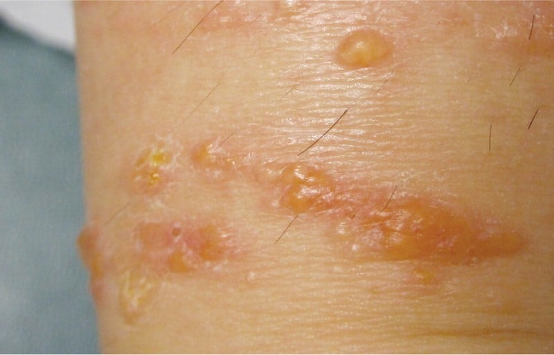 The 15 Causes of Dyshidrotic Eczema You Should Be Aware Of - OptingHealth
