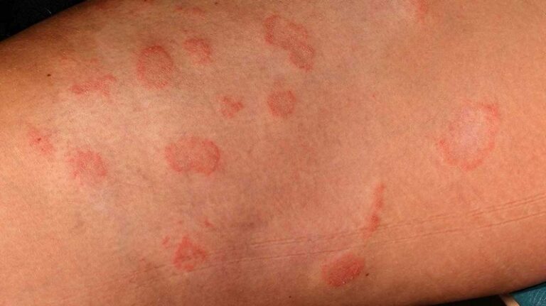 12 Causes & Triggers of Balanitis You Shouldn't Ignore (List ...