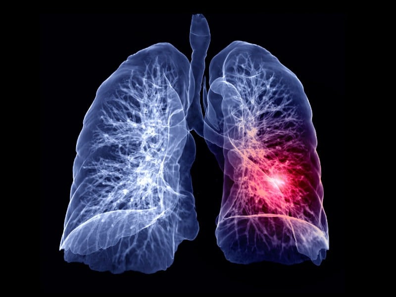 10 Causes & Common Triggers Of Fluid In Lungs (You Should Know ...