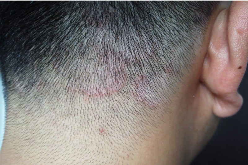 9 Itchy Scalp Causes You Should Know (Common Triggers) - OptingHealth