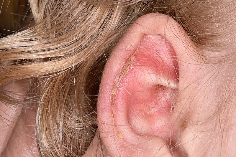 12 Causes And Triggers Of Ear Infection You Shouldnt Ignore List Optinghealth 