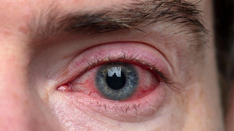 What Are The Triggers Of Eye Pain? 14 Common Causes - OptingHealth