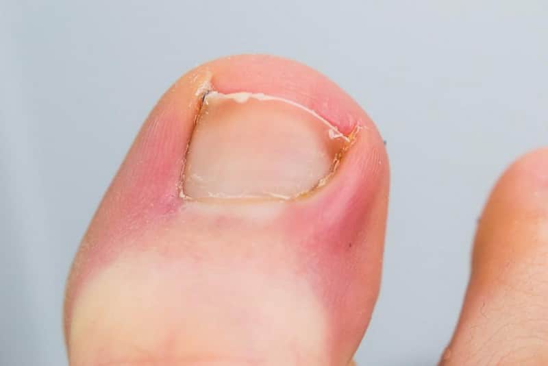 6-natural-remedies-for-ingrown-toenails-ingrown-toe-nail-health-toe