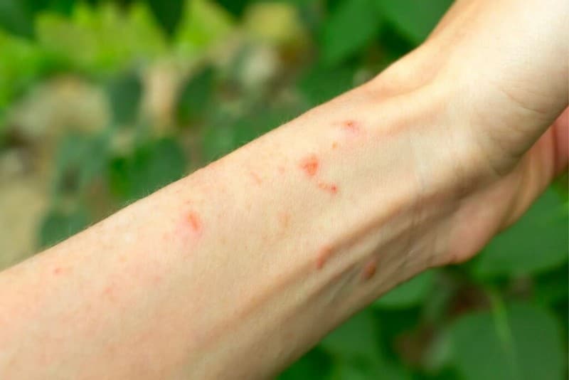 15-home-remedies-for-poison-ivy-how-to-get-rid-of-it-optinghealth