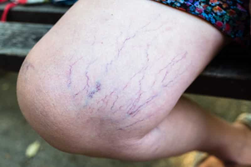 15 Common Causes of Spider Veins You Shouldn't Ignore OptingHealth