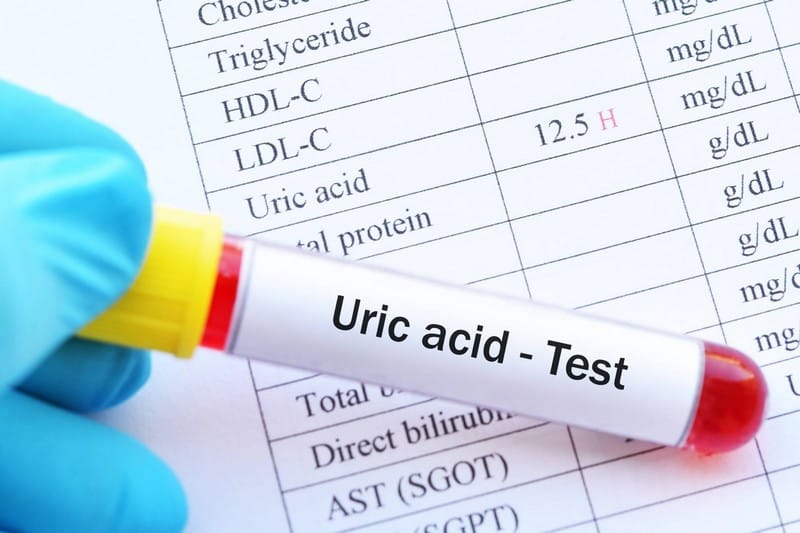 10 signs and symptoms of uric acid to know optinghealth