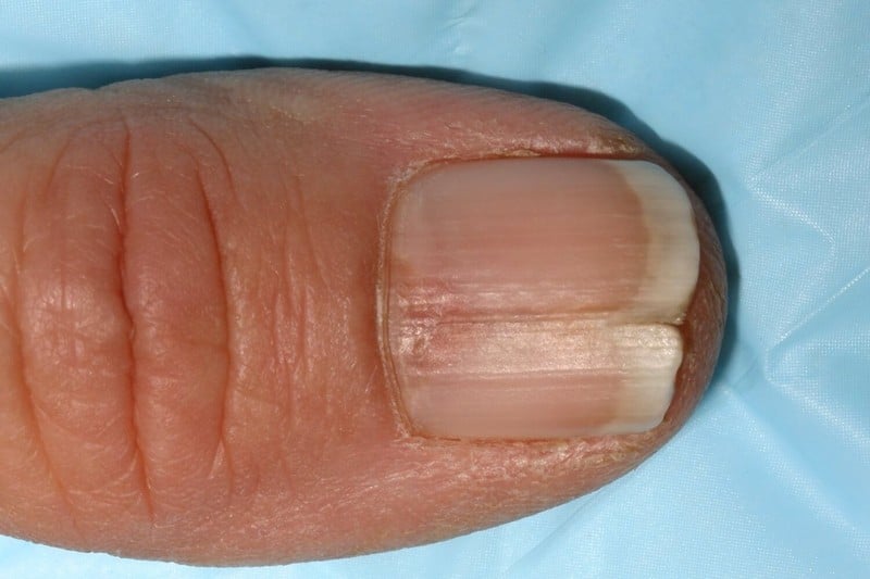 what-are-the-triggers-of-vertical-split-nails-15-common-causes